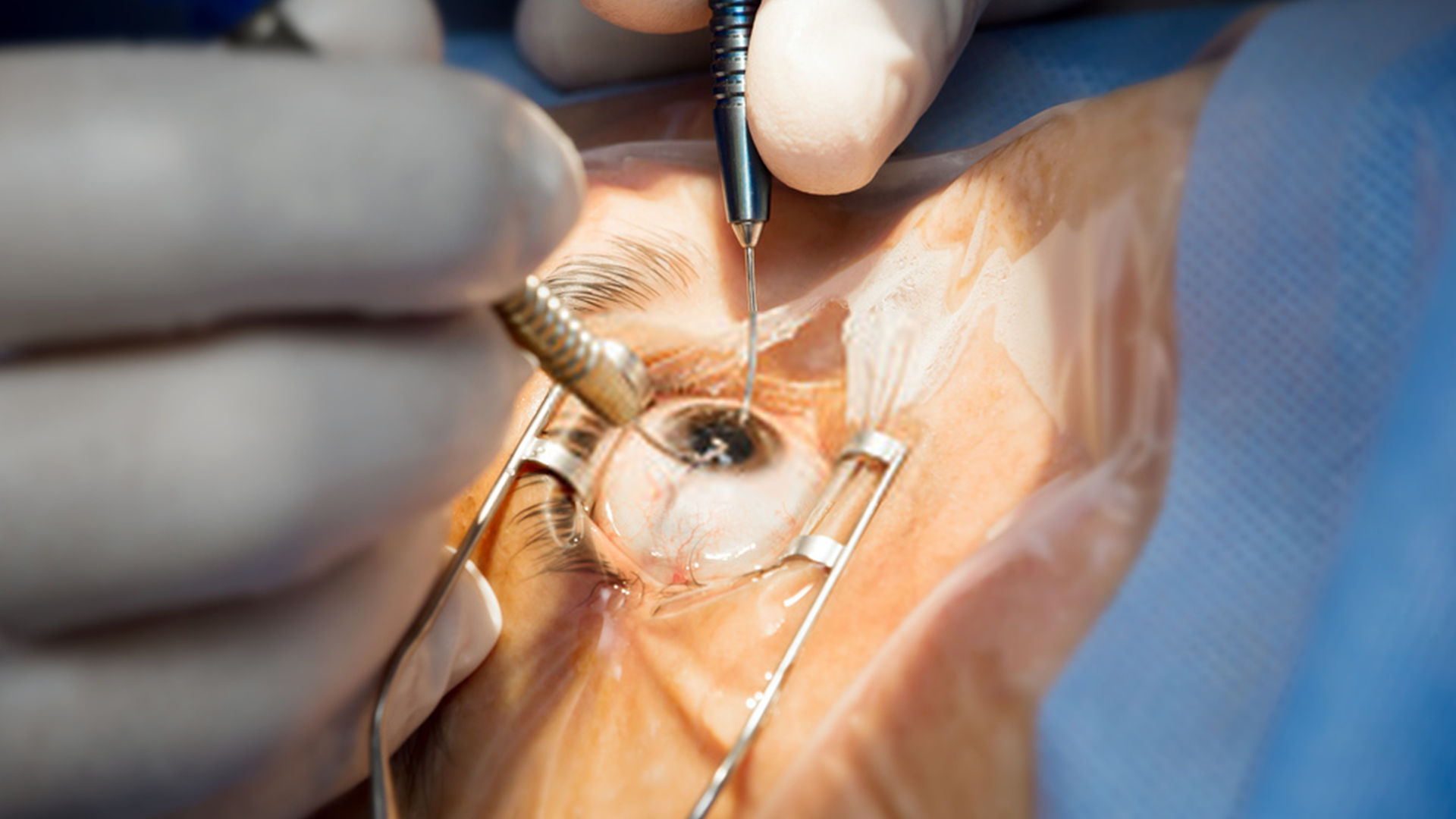 advanced sutureless cataract surgery in mulund